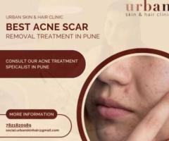 Effective Acne Scar Treatment in Pune by Dr. Kiran