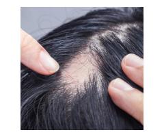 Wigs For Alopecia | Wigmedical.com
