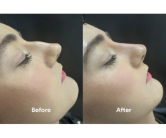 Non-Surgical Nose Reshaping in Chiswick – Book a Free Consultation