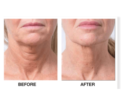 Profhilo Skin Booster in Colchester, Essex – Book a Free Consultation
