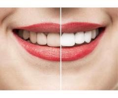 Teeth Whitening in Mount Roskill, Auckland