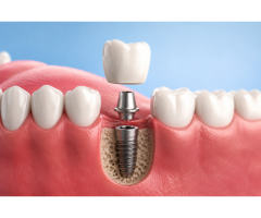 Dental Implants in Perth – Restore Your Smile with Iluka Dental Centre